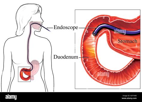 Upper GI Endoscopy Stock Photo: 7710938 - Alamy