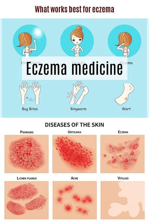 Eczema Skin Rashes Treatment