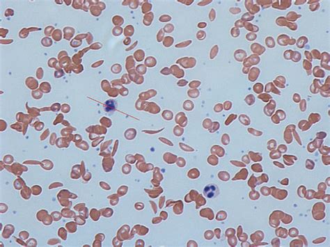 Normocytic Anemia: Sickle Cell Anemia (Sickle Cell Disease) | Lecturio