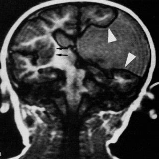 Brain MRI: lissencephaly type I. T1 weighed axial view: slight... | Download Scientific Diagram