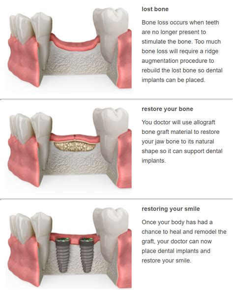 Ridge Augmentation - North Hills Periodontics