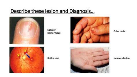 Rheumatic fever signs JONES 1-Migratory polyarthritis 2-carditis 3 ...