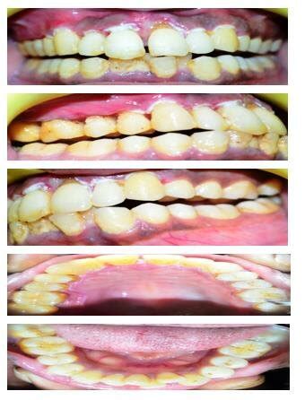 After Excisional biopsy of lesion. | Download Scientific Diagram