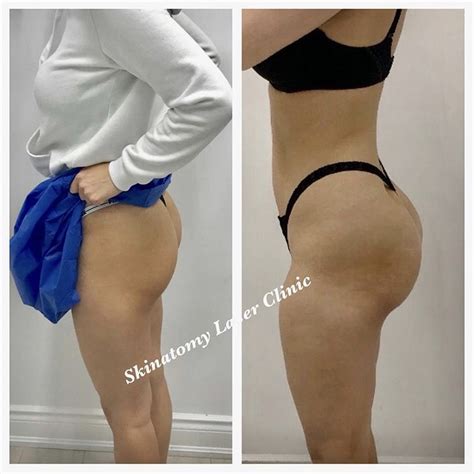 Sculptra Butt Lift - Non Surgical BBL Toronto - Skinatomy