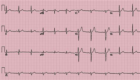 Advance Arrhythmia Review Course | EKG Certification Course Online