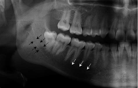 Mandibular Posterior Landmarks Intraoral Radiographic, 59% OFF