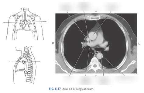 Axial CT of lungs at hilum Diagram | Quizlet