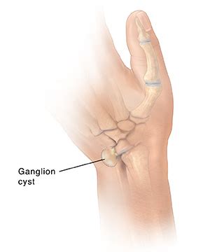 Quiste ganglionar: mano | Sistema de Salud de San Lucas | SG Web