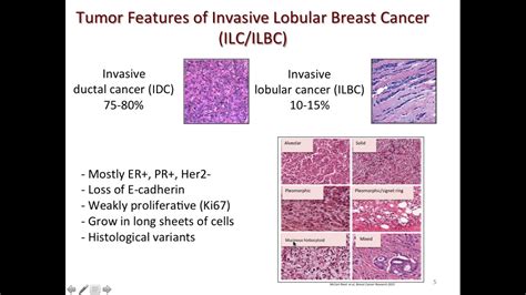 Invasive Lobular Carcinoma Image