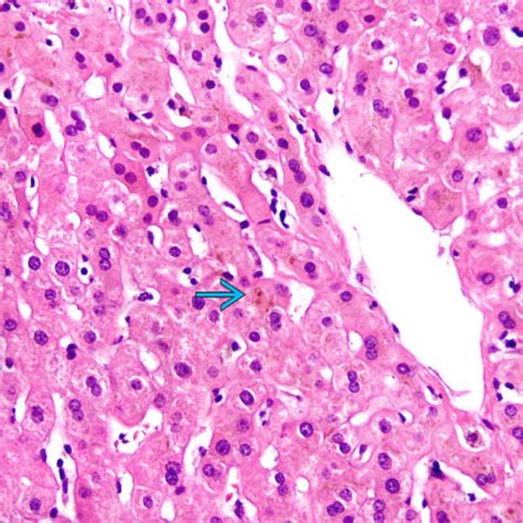 Drug-Induced Cholestatic Liver Injury | Basicmedical Key