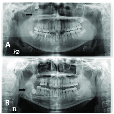 Odontogenic Keratocyst Radiology