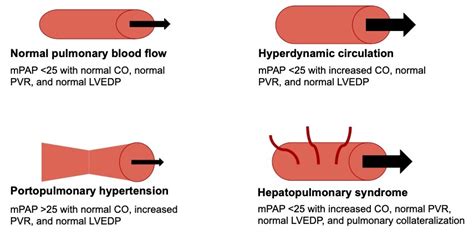 Hepatopulmonary Syndrome - OpenAnesthesia