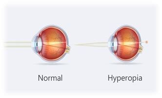 Symptoms and sings of Hyperopia - Optography