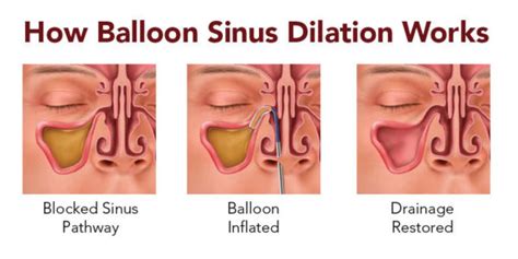 What It's Like Getting A Balloon Sinuplasty Procedure - Westside Sinus