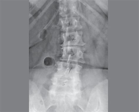 Simple X-ray of patient with degenerative scoliosis. | Download ...