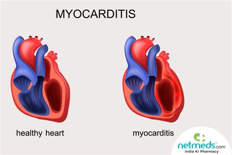 Child Myocarditis Symptoms : Pediatric Heart Failure A Practical Guide To Diagnosis And ...