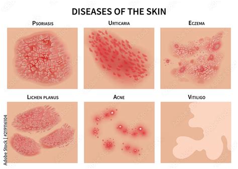 Skin diseases. Derma infection, eczema and psoriasis. Dermatology ...