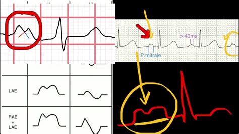 LEFT ATRIUM ENLARGEMENT.. *EKG FEATURES - YouTube