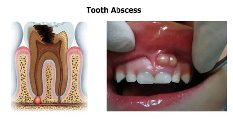 5 Potential Causes of Toothache and Ways to Deal With It | Healthtian