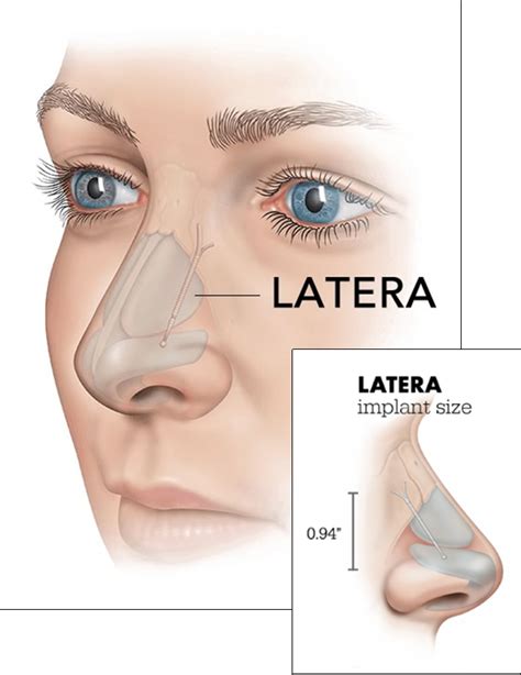 Florida Nose and Sinus DoctorLATERA® Nasal Implant - ENT Florida