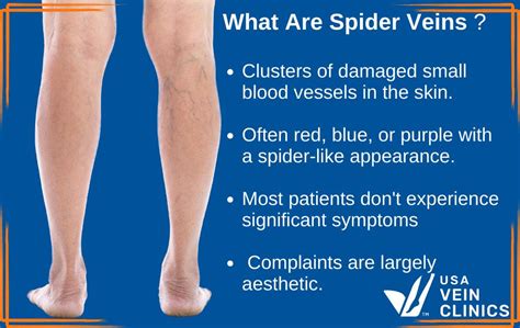 Mild Spider Veins On Legs