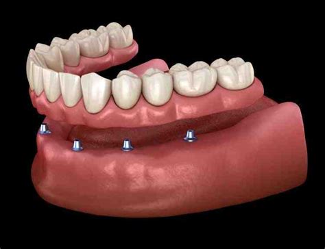 How much are full mouth dental implants - Dental News Network