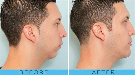 jawline exercise for men before and after - YouTube