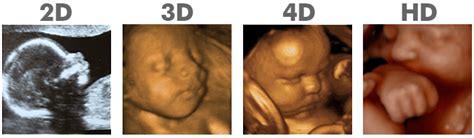 HD Ultrasound Pricing - 3D ultrasound packages - Clearview Ultrasound