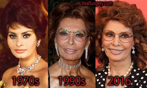 Sophia Loren Plastic Surgery, Before and After Facelift Pictures