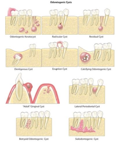 P7 - Odontogenic Cysts Flashcards | Quizlet