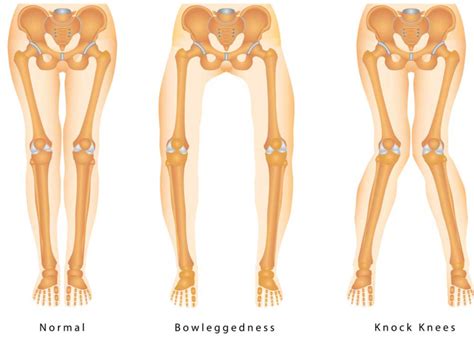 Bow Legged | Knocked Knees | Vail, Aspen, Colorado Springs, Denver CO