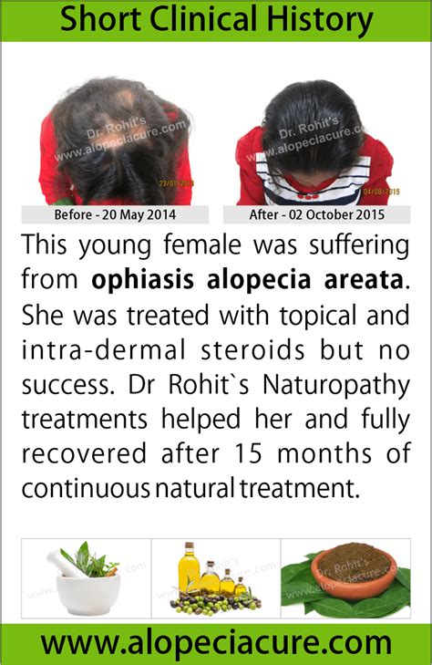 ophiasis alopecia areata treatment