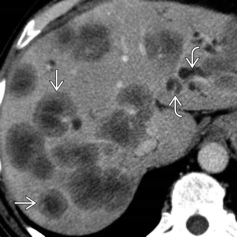 Hepatic Metastases and Lymphoma | Clinical Gate