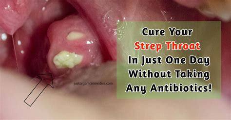 Can Strep Make Your Teeth Hurt - Teeth Poster