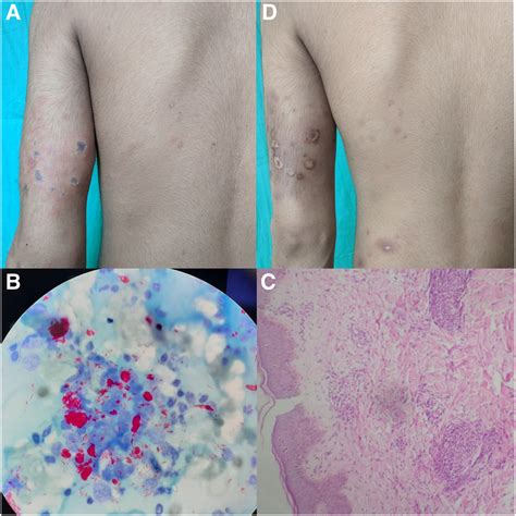 Lichenoid Skin Nodules as Presenting Feature of Necrotic Erythema Nodosum Leprosum in Leprosy in ...