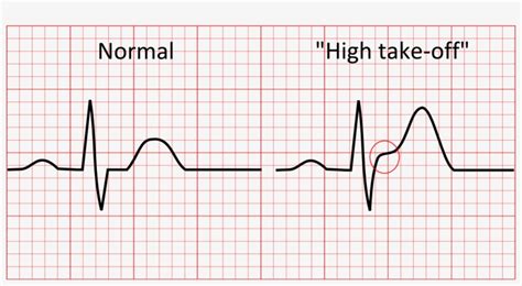 This Normal Variant Of The Ecg Represents Early Repolarisation - Normal ...