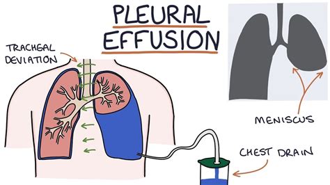 Understanding Pleural Effusions | เนื้อหาที่เกี่ยวข้องatelectasis คือที่แม่นยำที่สุด