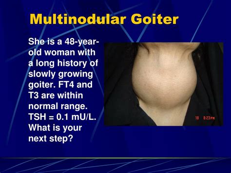 PPT - Simple (Nontoxic) Goiter: Diffuse and Multinodular PowerPoint ...