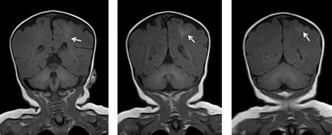 Focal cortical dysplasia – Radiology Cases