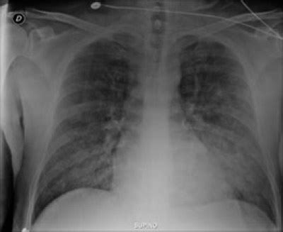 emDOCs.net – Emergency Medicine EducationEM@3AM: Crack Lung - emDOCs.net - Emergency Medicine ...