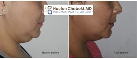 Reducing Neck Fat without Plastic Surgery - Potomac Plastic Surgery