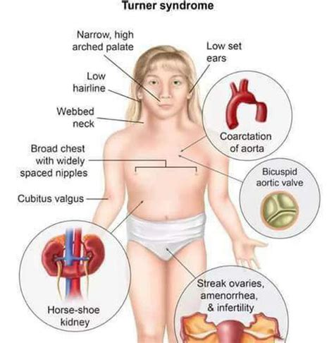 Clinical Signs of Turner Syndrome - MEDizzy