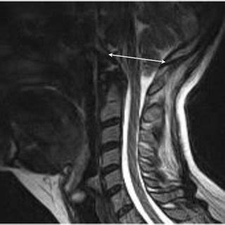 The Basion-Opisthion Line (double arrow). | Download Scientific Diagram