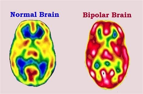 Bipolar Disorder - Symptoms, Types, Causes and Complications - How to ...