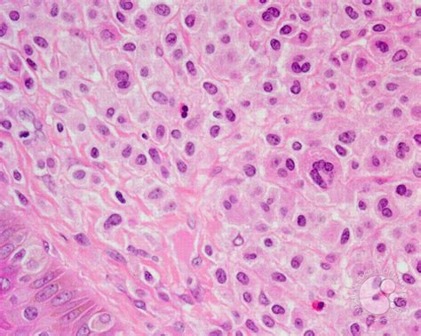 Cutaneous lesions in systemic mastocytosis - 3.