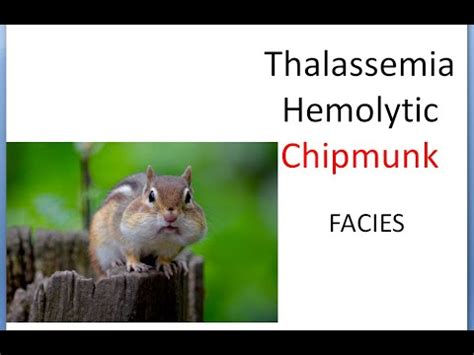 Pediatrics CHIPMUNK Thalassemia facies face looks how they - YouTube