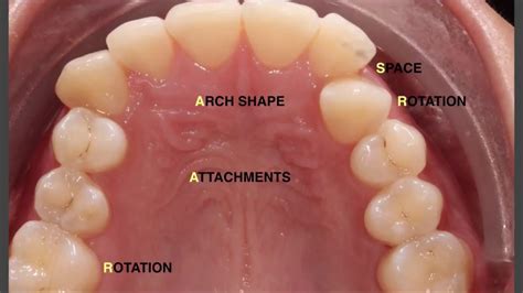 Invisalign to solve a severe crossbite - YouTube