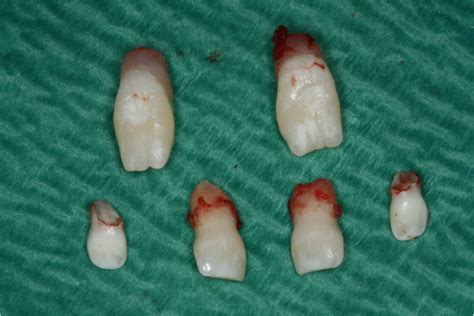 Extraction of deciduous and supernumerary teeth. | Download Scientific Diagram