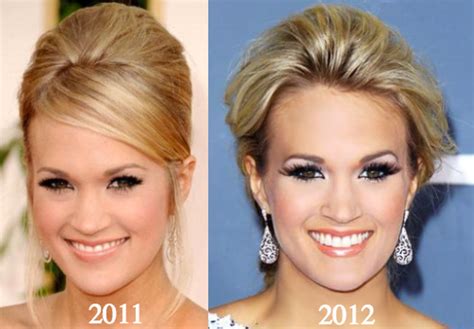 Carrie Underwood Plastic Surgery Before and After Photos