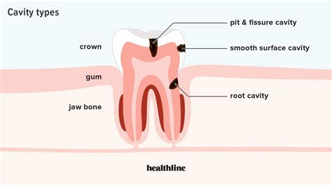 Root Cavity Causes, Symptoms, Diagnosis, and Treatment